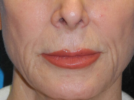 Lip Lift case #7003