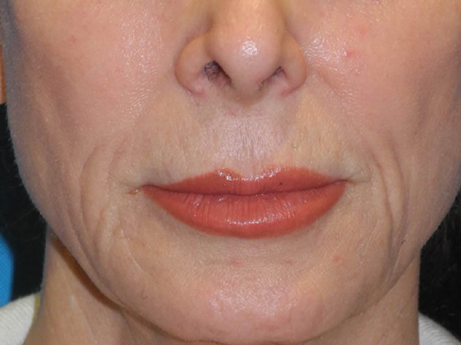 Lip Lift case #7003
