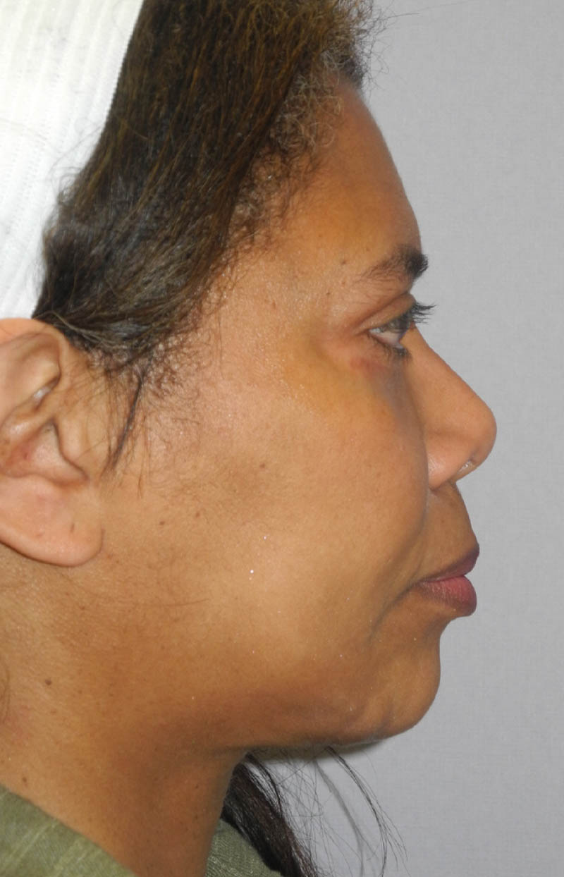 Neck Tuck case #6948