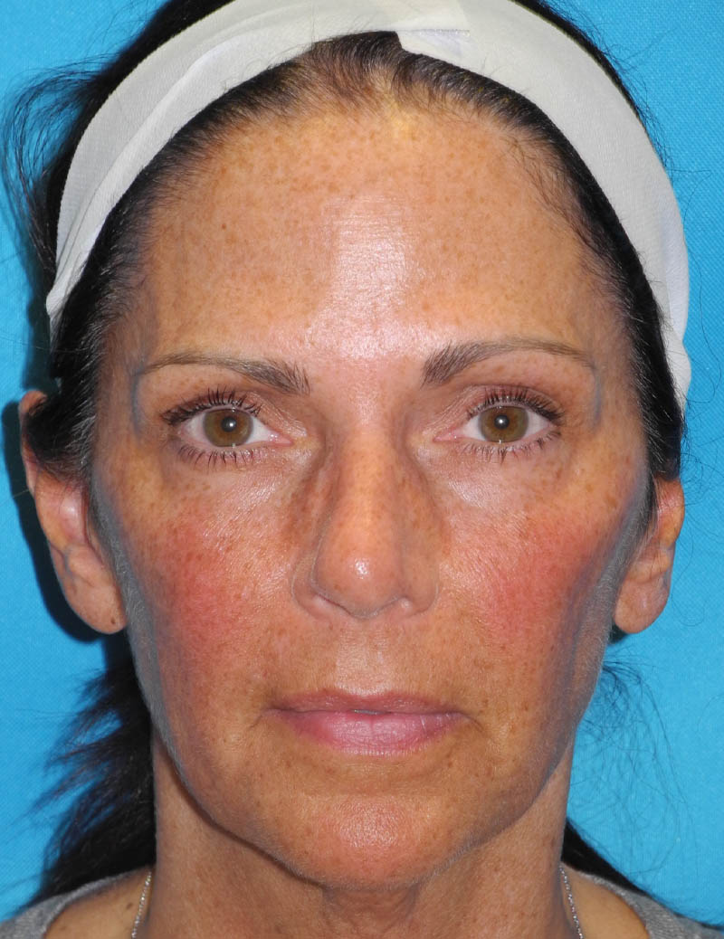 Neck Lift case #6923