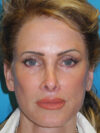 Brow Lift case #7010