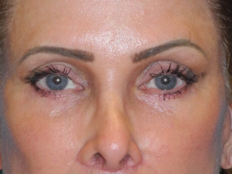Blepharoplasty case #7017
