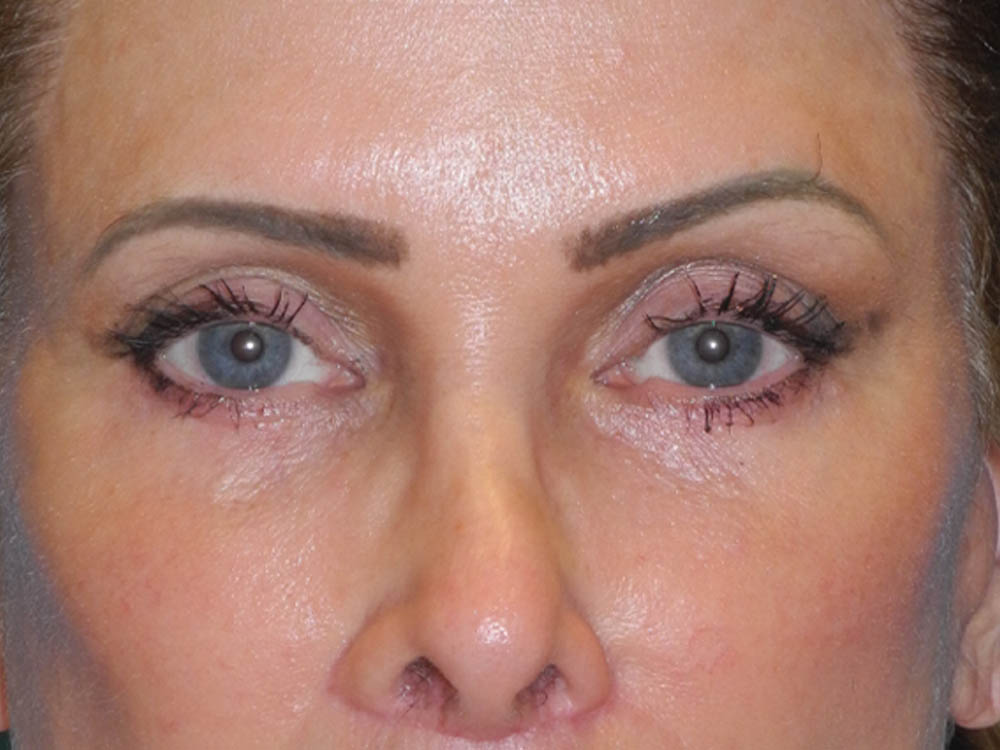 Blepharoplasty case #7017
