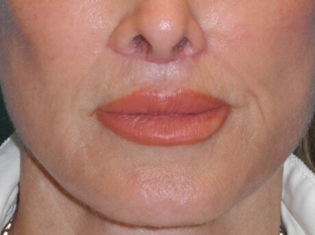 Lip Lift case #7003