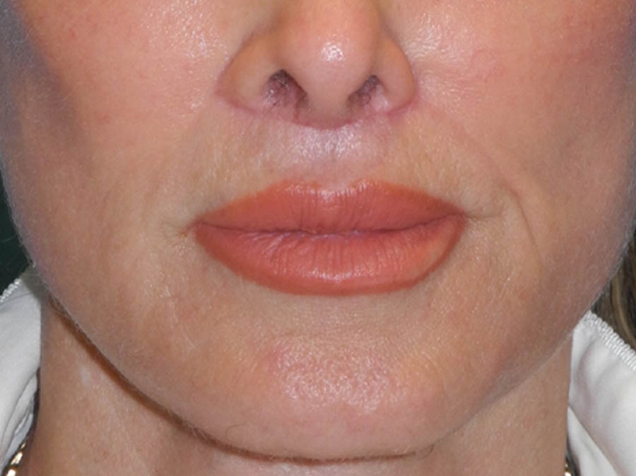 Lip Lift case #7003