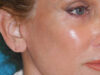 Earlobe Repair case #7033