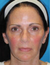 Neck Lift case #6923