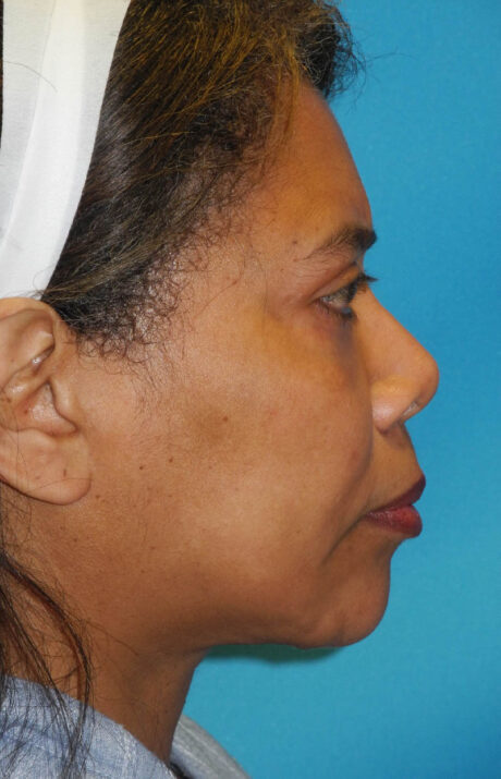 Neck Tuck case #6948