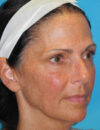 Neck Lift case #6923