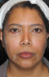 Neck Tuck case #6948