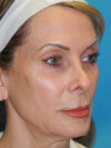 Brow Lift case #7010