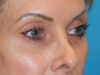 Blepharoplasty case #7017