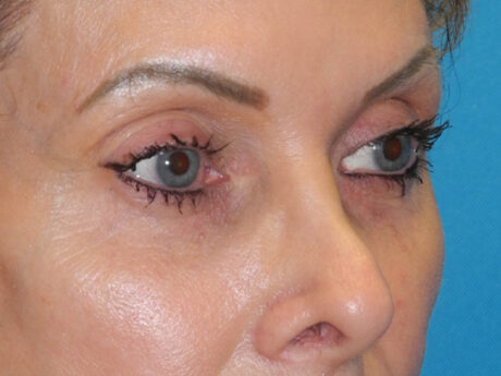 Blepharoplasty case #7017