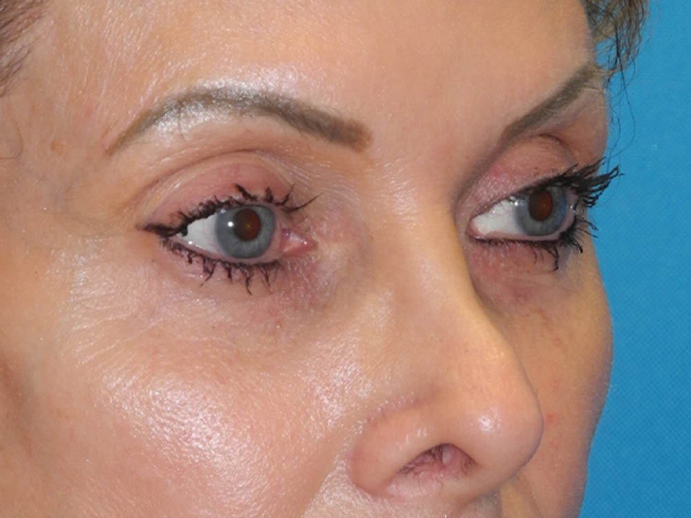 Blepharoplasty case #7017