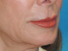 Lip Lift case #7003