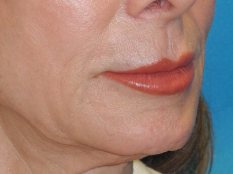 Lip Lift case #7003