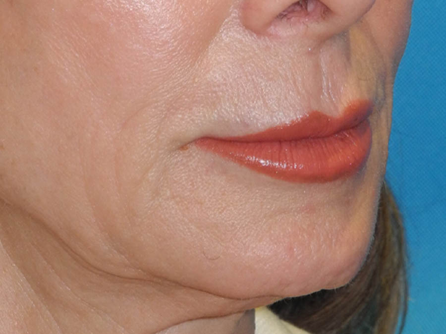 Lip Lift case #7003