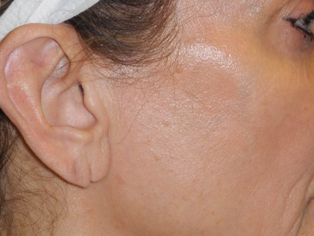 Earlobe Repair case #7033