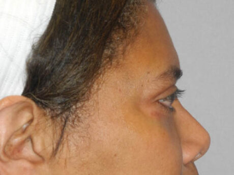 Blepharoplasty case #6940