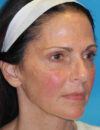 Neck Lift case #6923