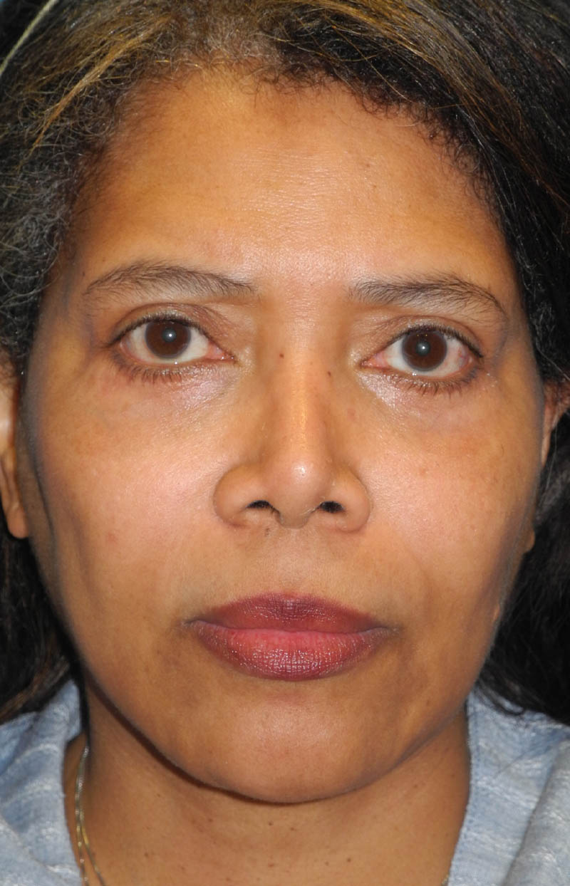 Neck Tuck case #6948