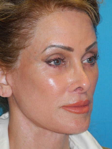 Brow Lift case #7010