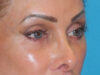 Blepharoplasty case #7017