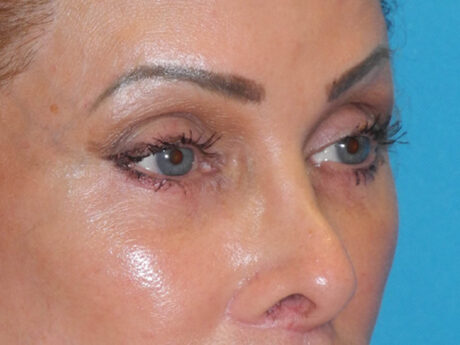 Blepharoplasty case #7017