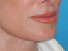 Lip Lift case #7003