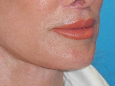 Lip Lift case #7003