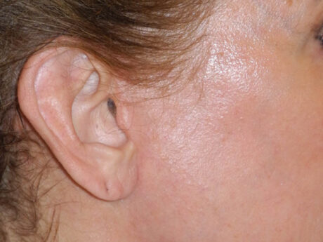 Earlobe Repair case #7033