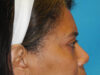 Blepharoplasty case #6940