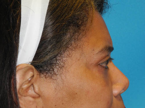 Blepharoplasty case #6940