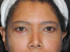 Blepharoplasty case #6940