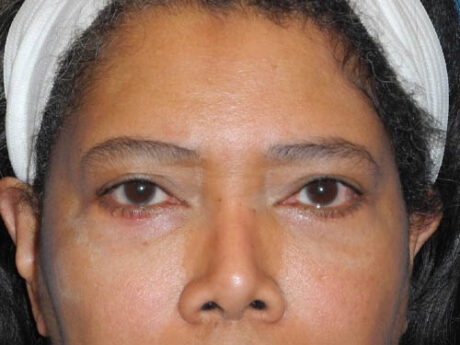 Blepharoplasty case #6940