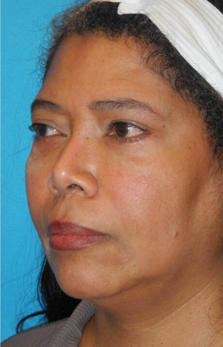 Neck Tuck case #6948