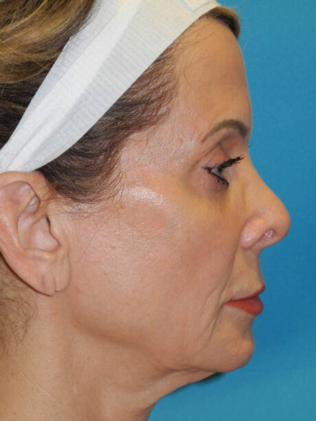 Brow Lift case #7010