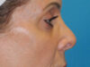 Blepharoplasty case #7017