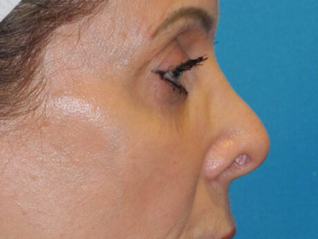 Blepharoplasty case #7017