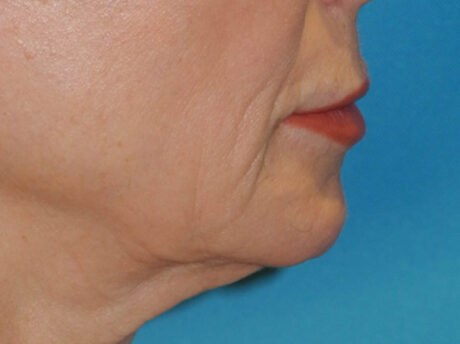 Lip Lift case #7003