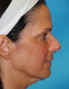 Neck Lift case #6923