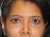 Blepharoplasty case #6940