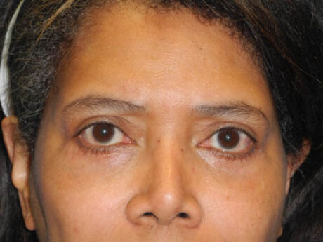 Blepharoplasty case #6940