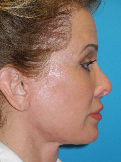 Brow Lift case #7010