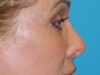 Blepharoplasty case #7017