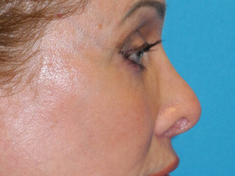 Blepharoplasty case #7017