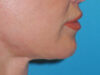 Lip Lift case #7003