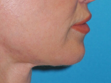 Lip Lift case #7003