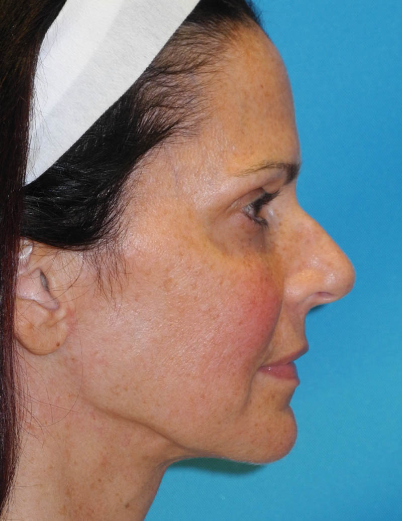 Neck Lift case #6923