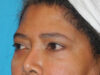 Blepharoplasty case #6940